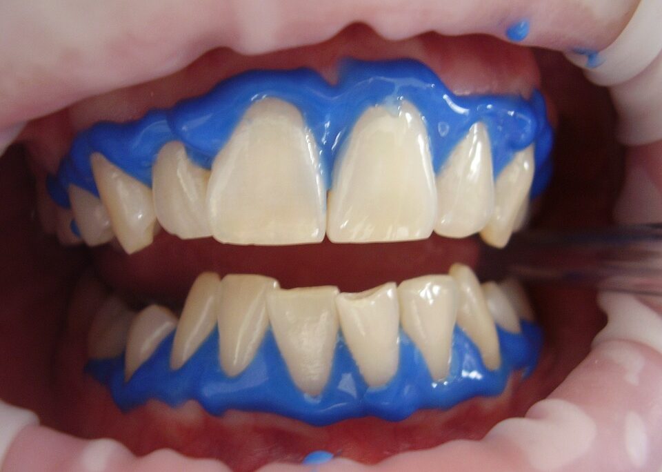 Professional Ways of Teeth Whitening and Procedures - Mplsdental