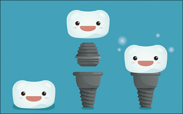 Dental Implants Dental Implants