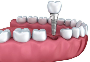 Benefits of Dental Implants