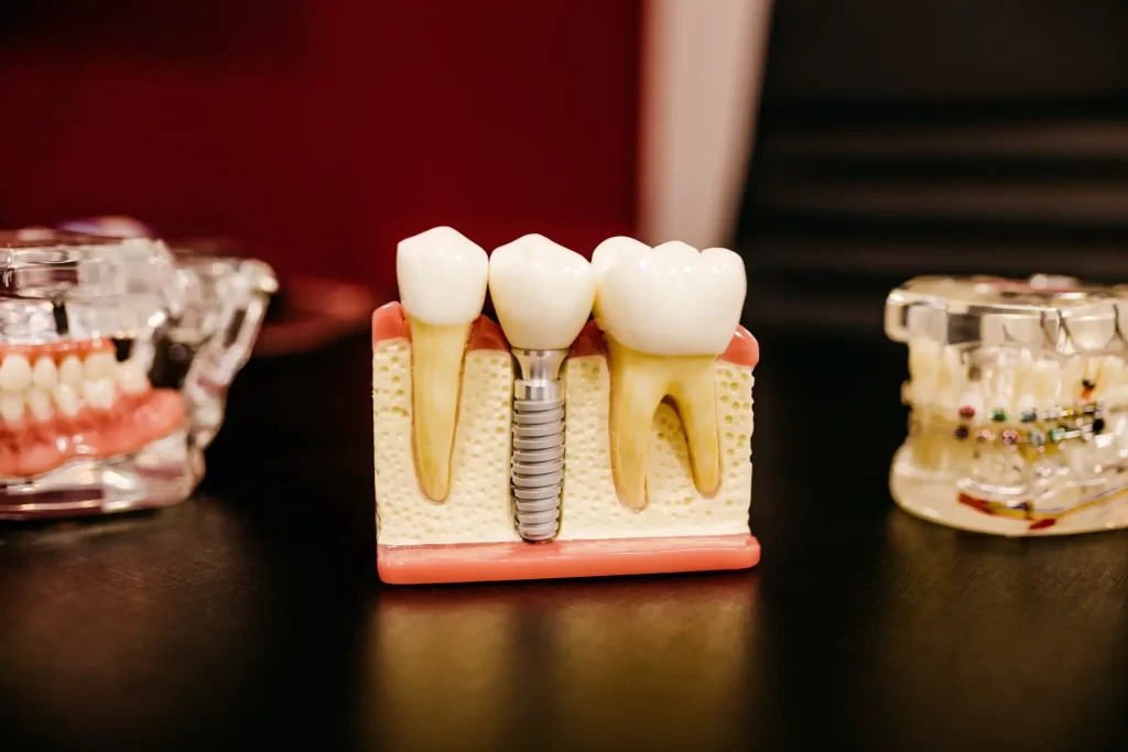 Dentist Near Me Implants