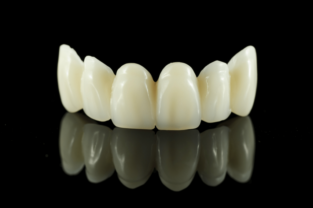 Porcelain Veneers Crowns