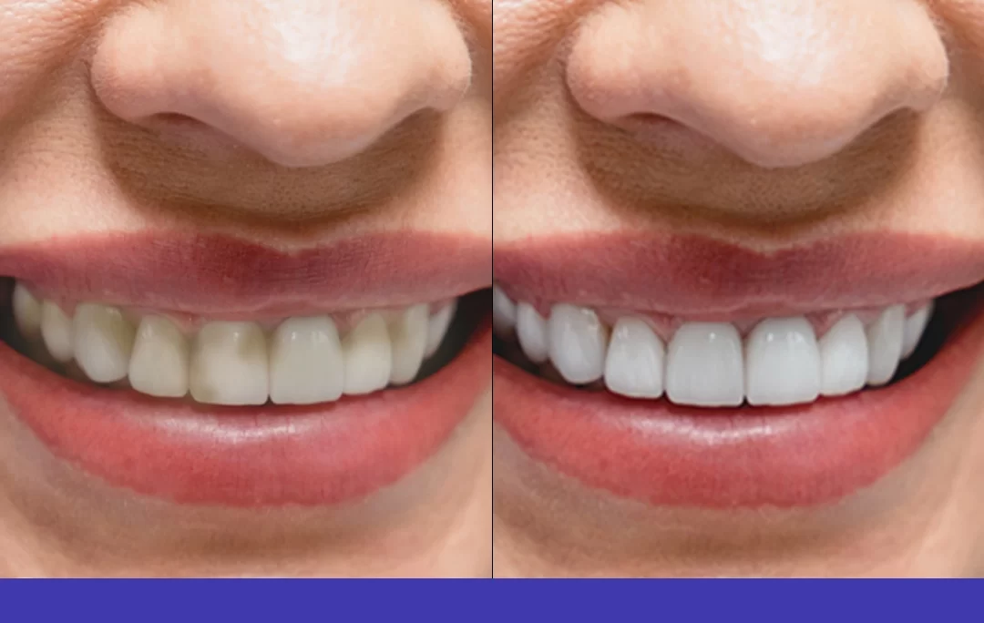 Most Natural Looking Veneers For Broken Teeth
