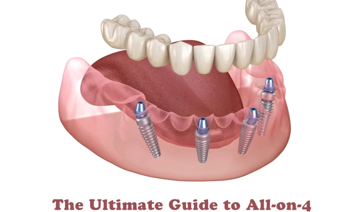The Ultimate Guide to All-on-4 Dental Implants
