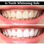 Is Teeth Whitening Safe