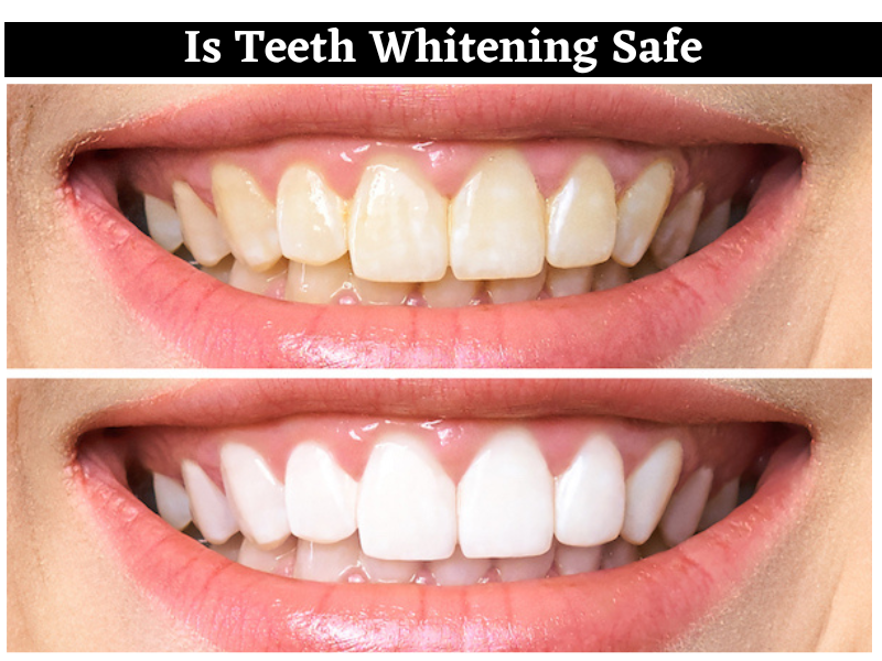 Is Teeth Whitening Safe